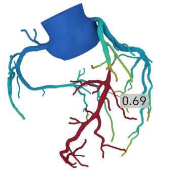 A schematic model of heart vessels